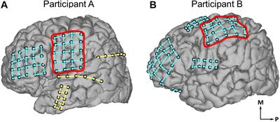 Somatosensation Evoked by Cortical Surface Stimulation of the Human Primary Somatosensory Cortex